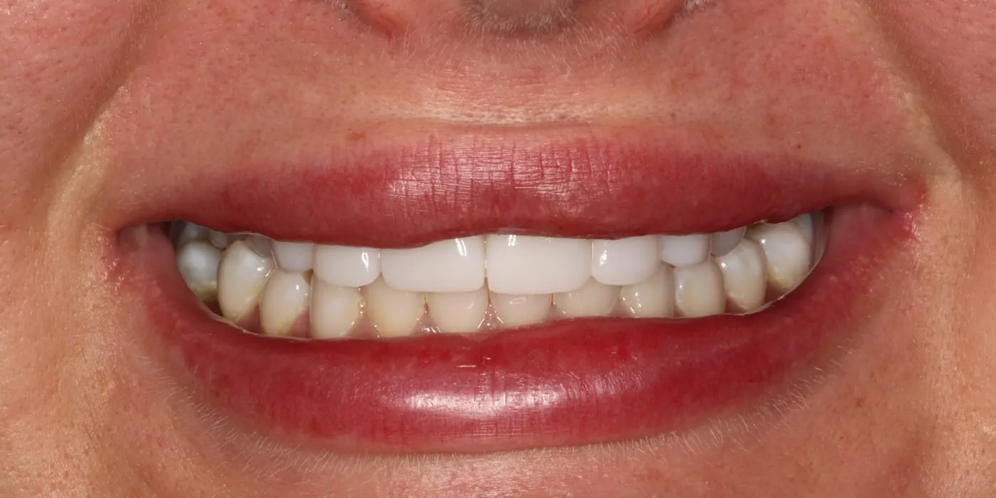 Case 1, after treatment
