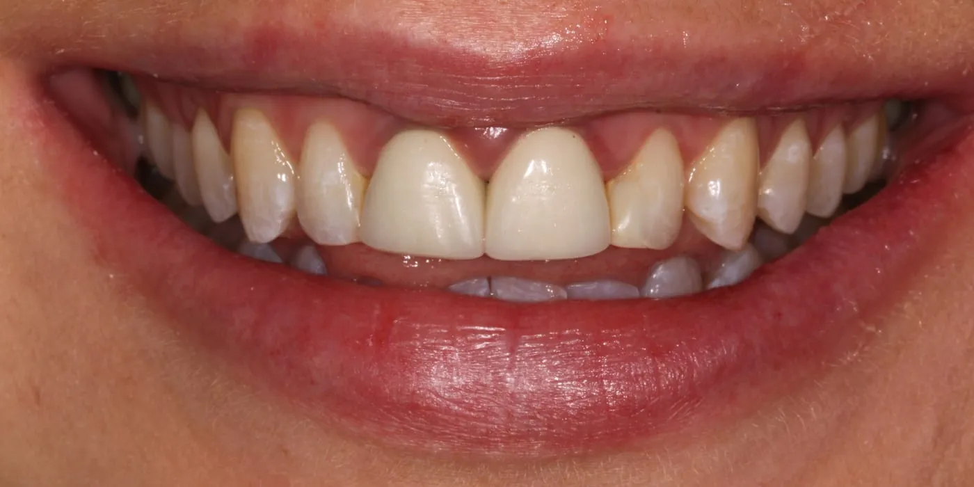 Case 3, before treatment