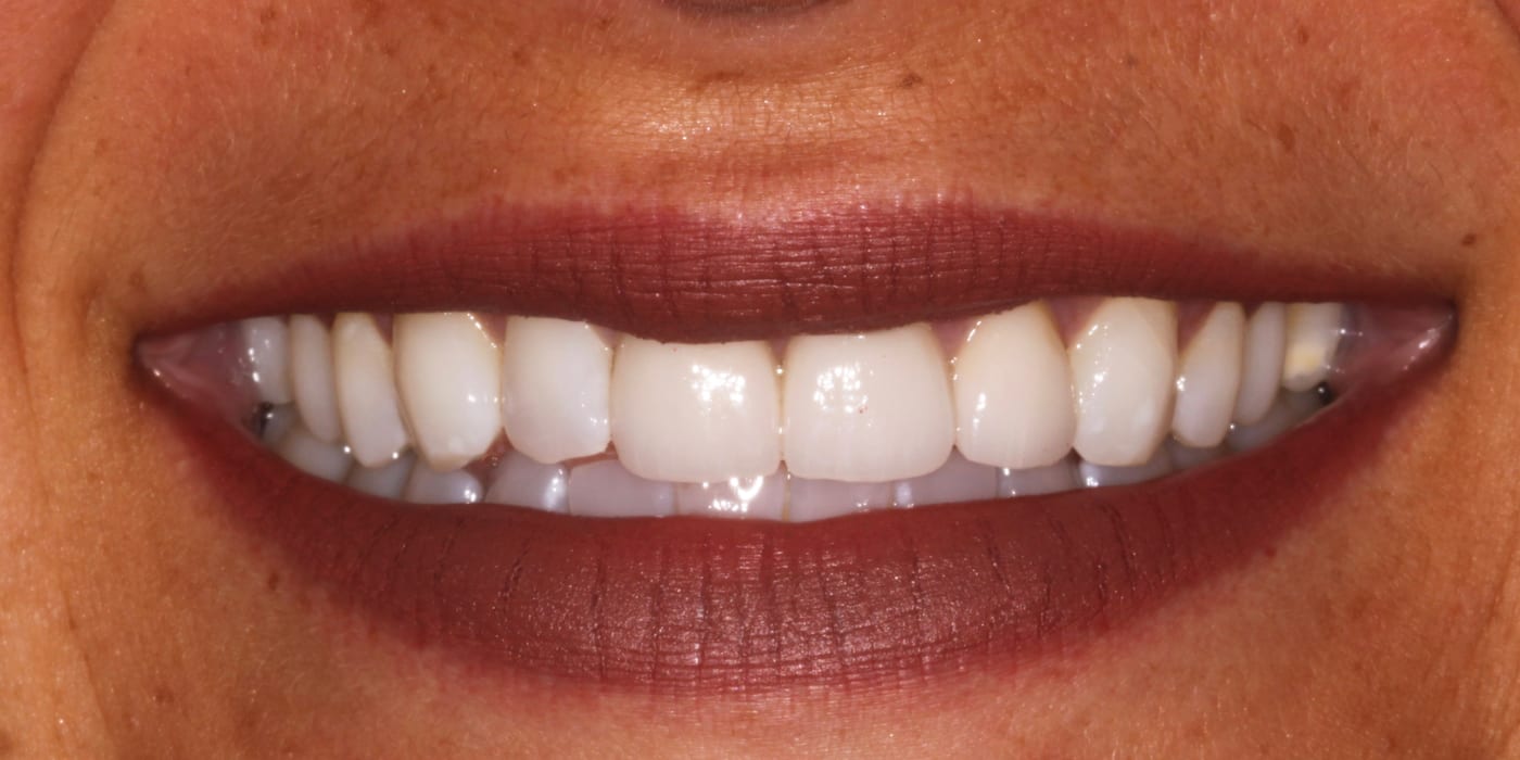 EMAX veneers after treatment, photographed at Medical-Dent