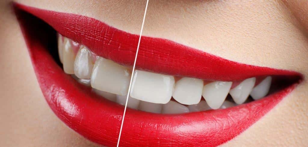 A split image showing different tooth shades