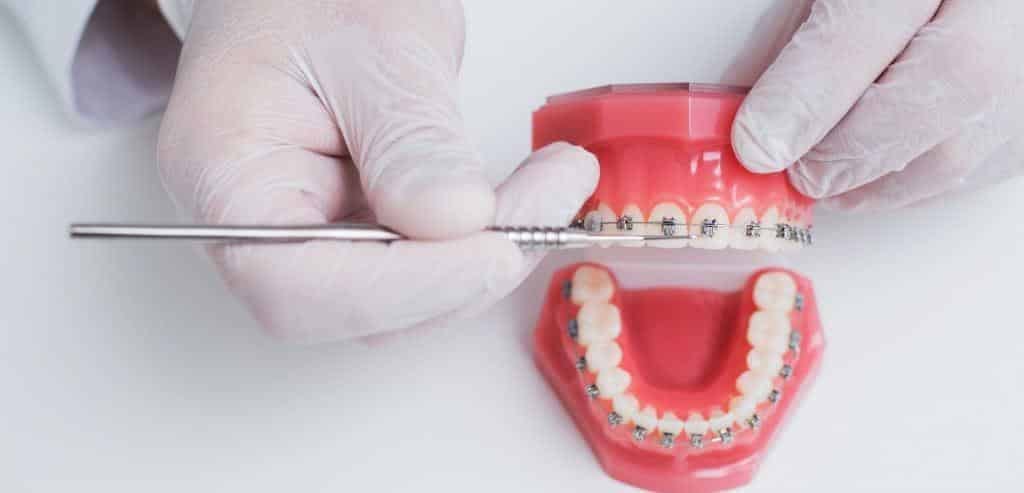 An instrument beside fixed braces on a dental model