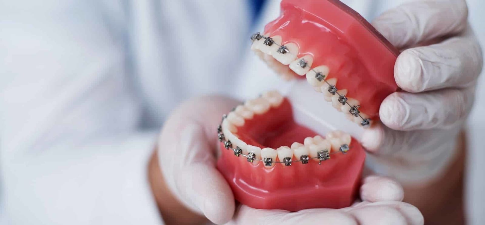 Gloved hands holding a dental model fitted with braces
