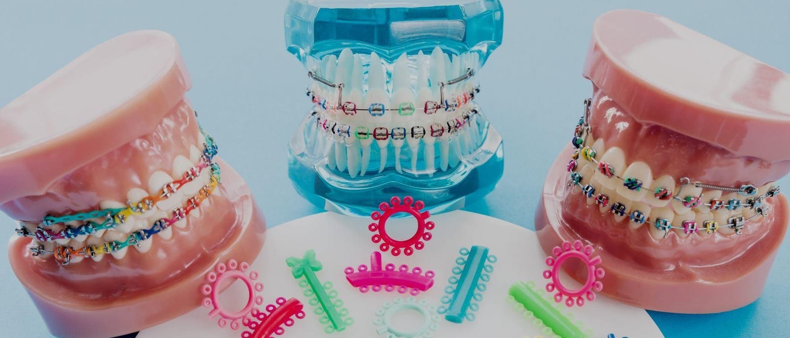 Dental models with braces and coloured elastics