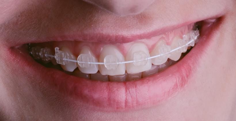 Clear brackets on upper front teeth