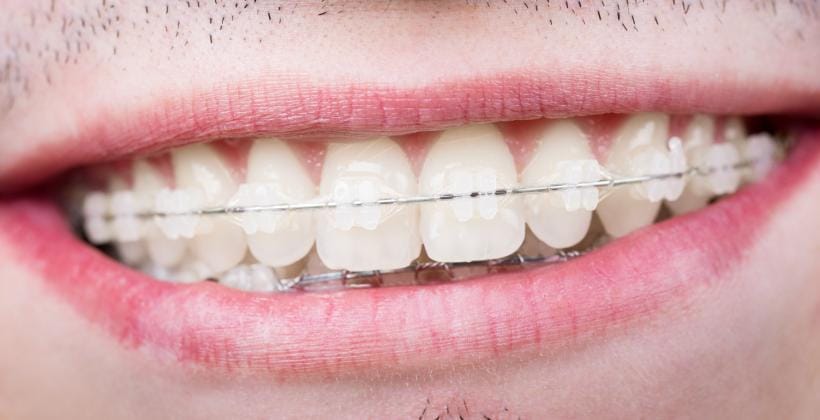 A close-up of teeth with clear brackets and an orthodontic wire