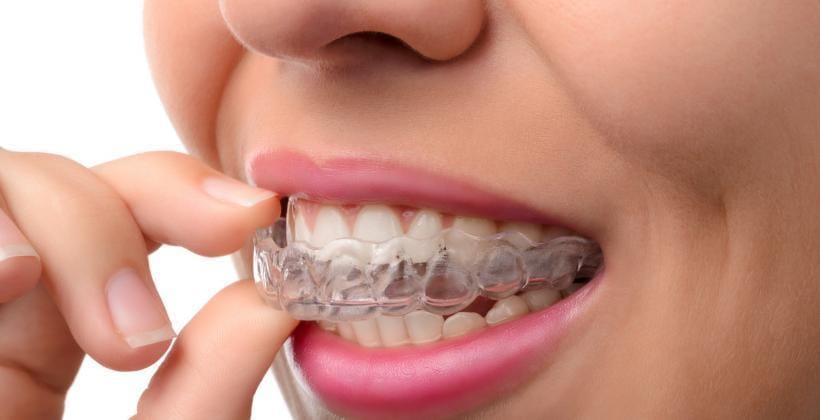 A person fitting a clear retainer over their teeth