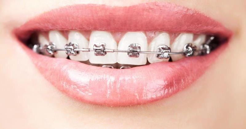 Metal brackets and a wire on upper teeth