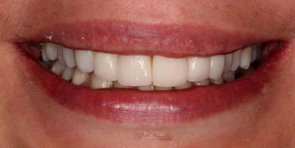 Close-up of a smiling mouth showing the front teeth