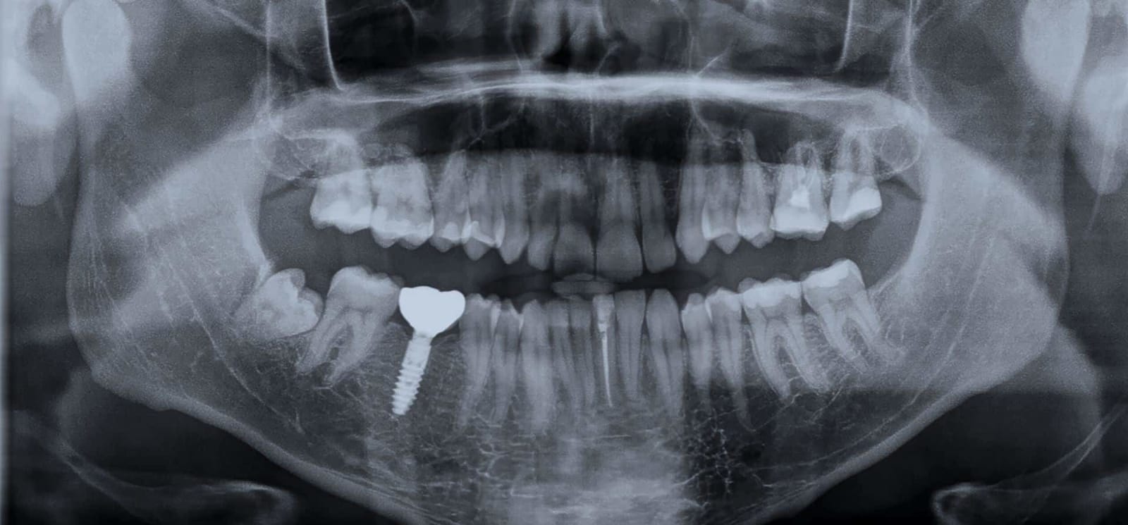 Panoramic dental X-ray showing an implant