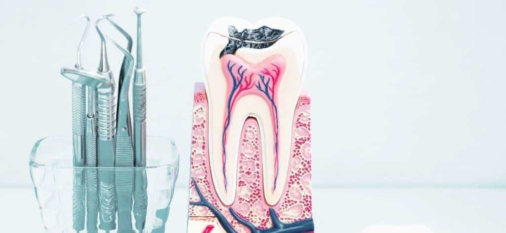 A cutaway tooth model beside dental instruments