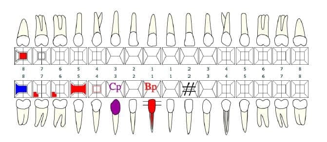 Dental chart with coloured markings on individual teeth