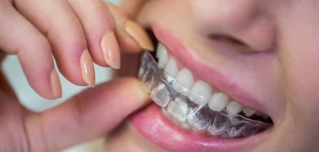 A person fitting a clear dental tray over their teeth