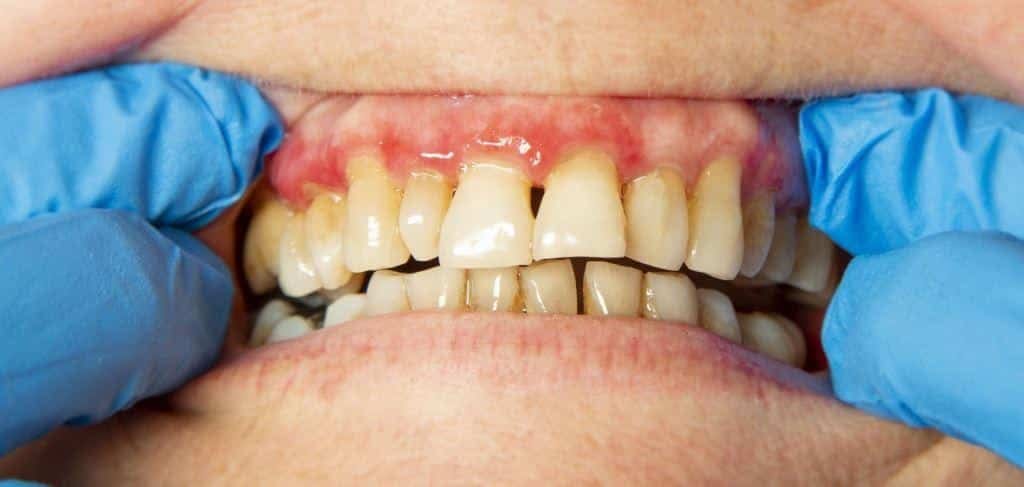 A close-up of teeth and gums