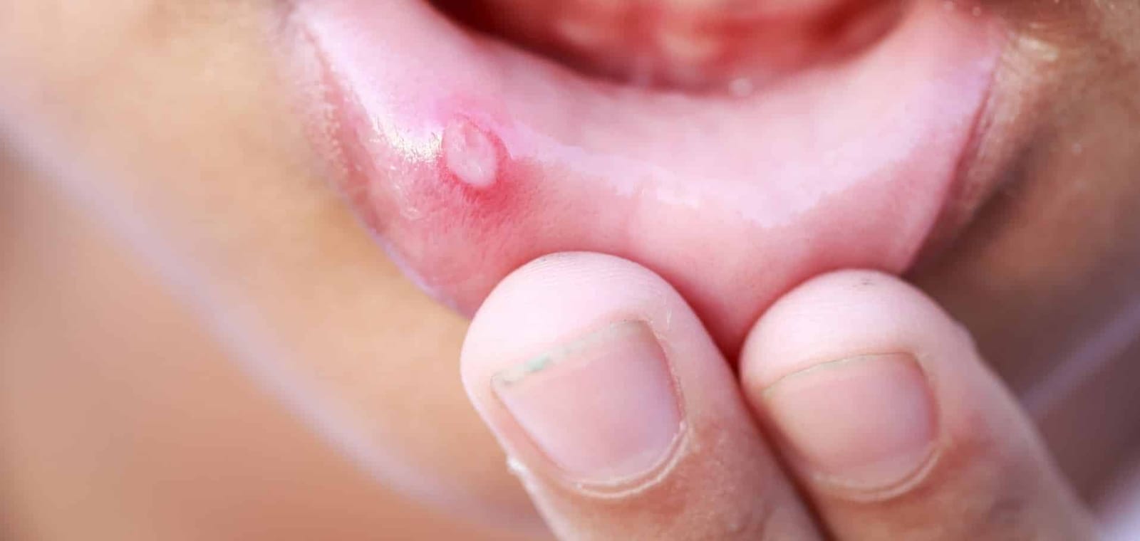 A small pale sore on the inside of a lower lip