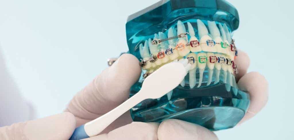 A toothbrush demonstrating cleaning on a model with fixed braces