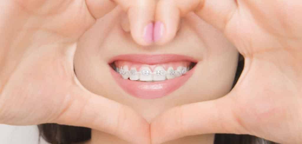 A person with fixed braces framing their smile with their hands