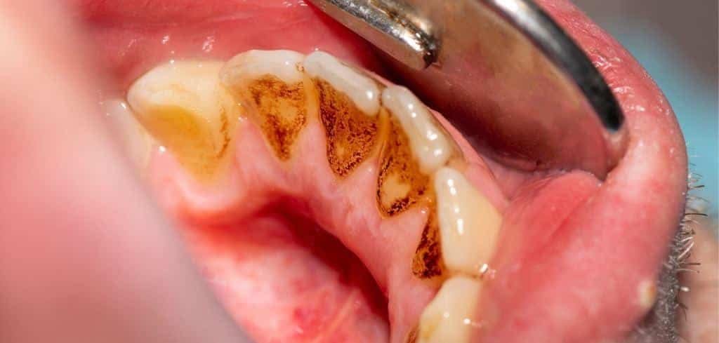 Brown deposits on the inner surfaces of lower teeth beside a dental mirror