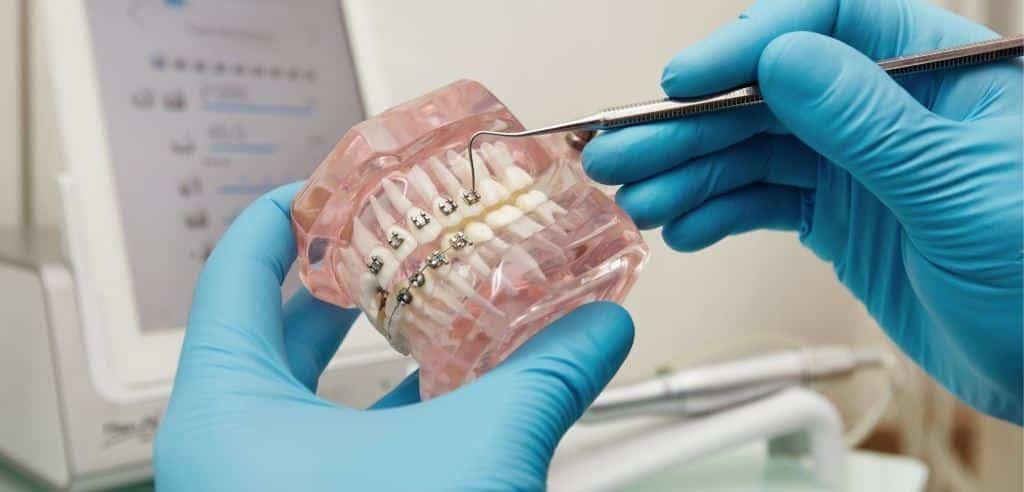 Gloved hands holding a model of teeth with fixed braces