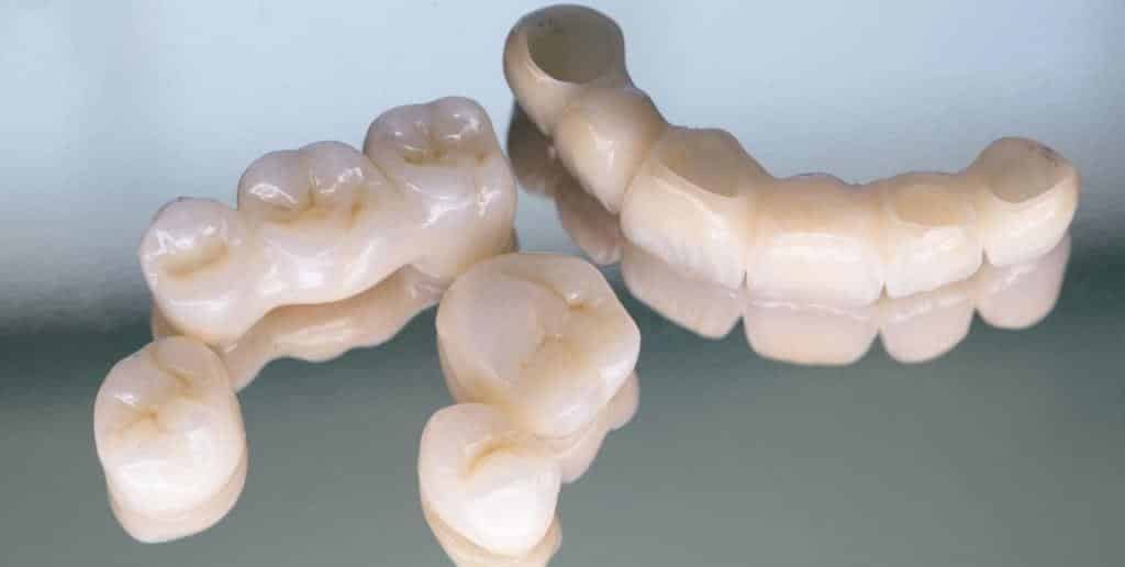 Several tooth-coloured dental bridges viewed from different angles