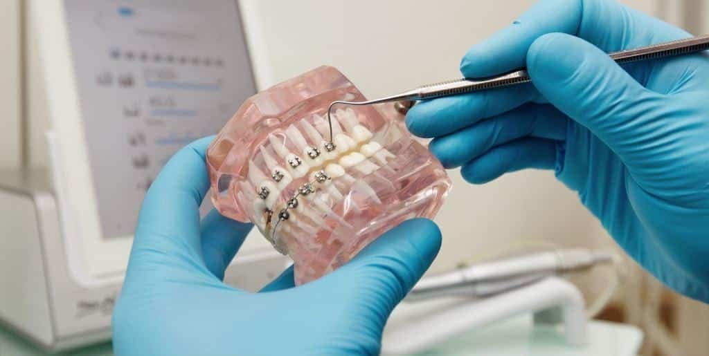 Gloved hands demonstrating fixed braces on a dental model