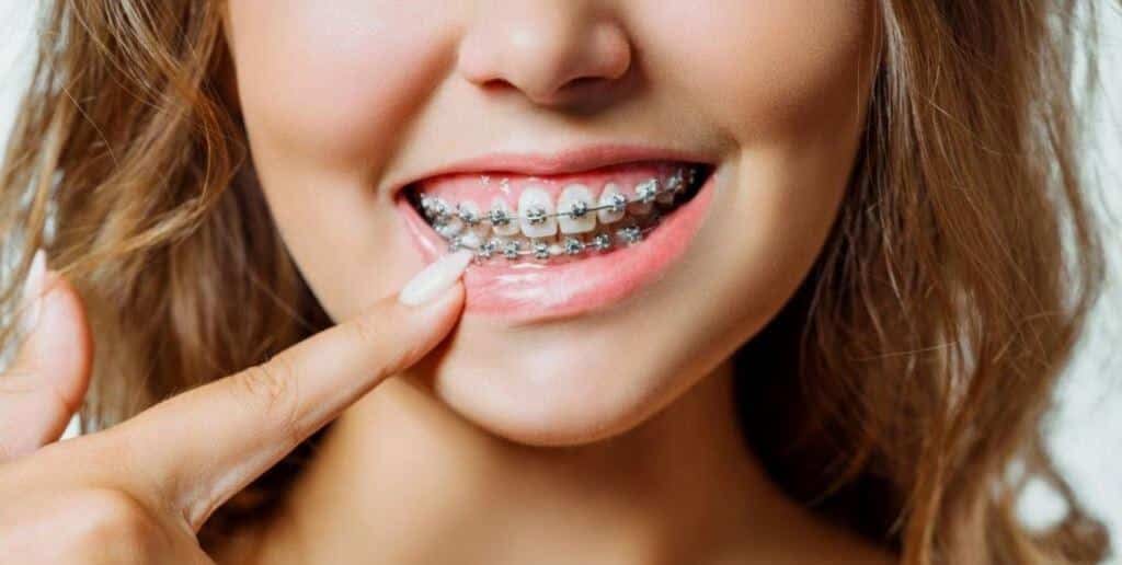 A person smiling with fixed metal braces