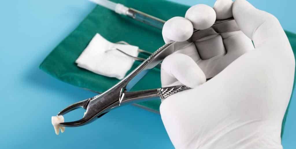 Dental forceps holding an extracted tooth