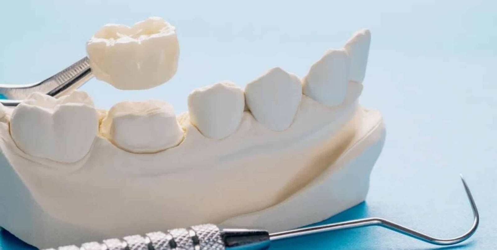 A crown held above a prepared tooth on a dental model