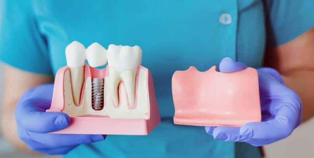 Gloved hands holding a cross-section dental model showing an implant