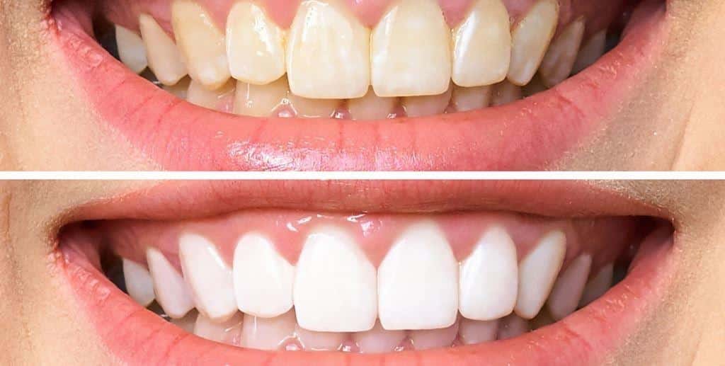 Two close-up photographs of front teeth with different visible shades and surface deposits