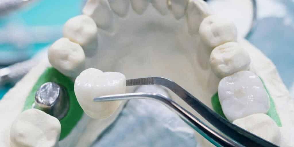 A dental crown held with tweezers above a model of teeth