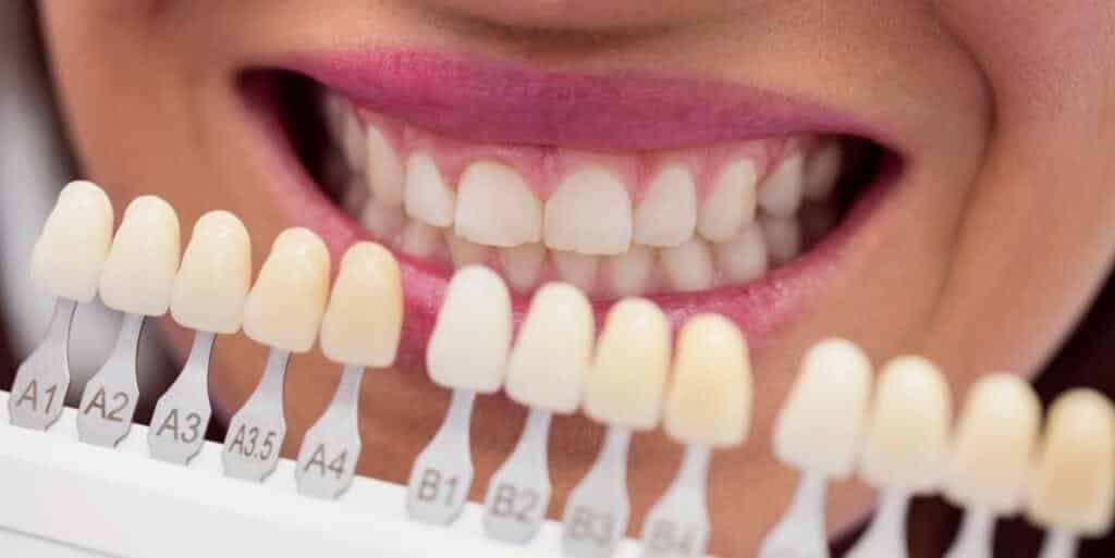 A tooth shade guide held beside a smiling mouth