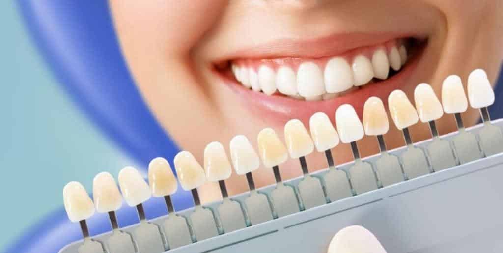 A tooth shade guide held beside a smiling mouth
