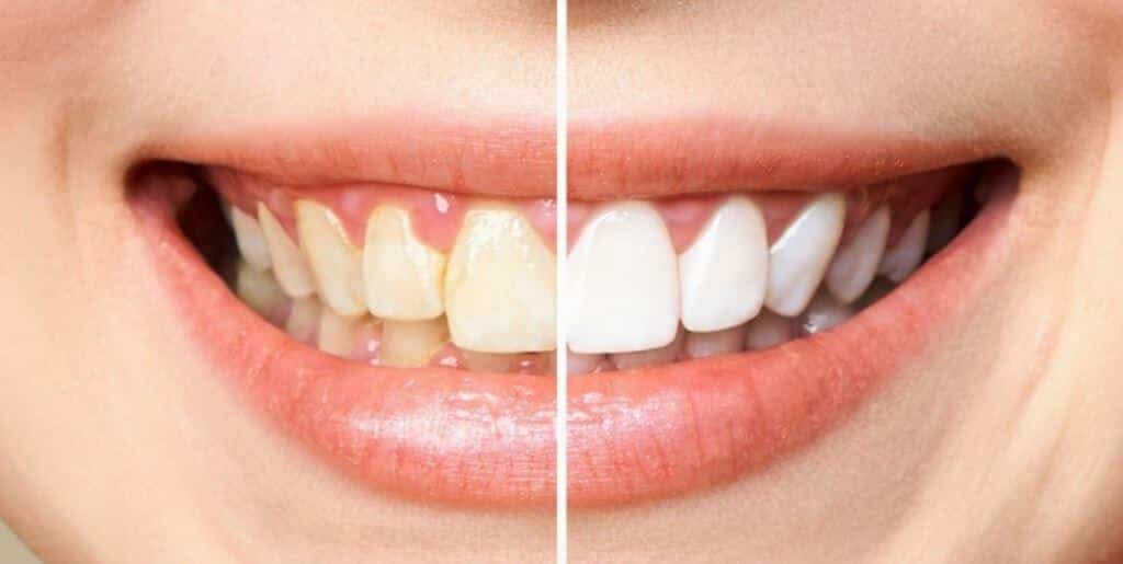 A split image showing a smile in two different shades