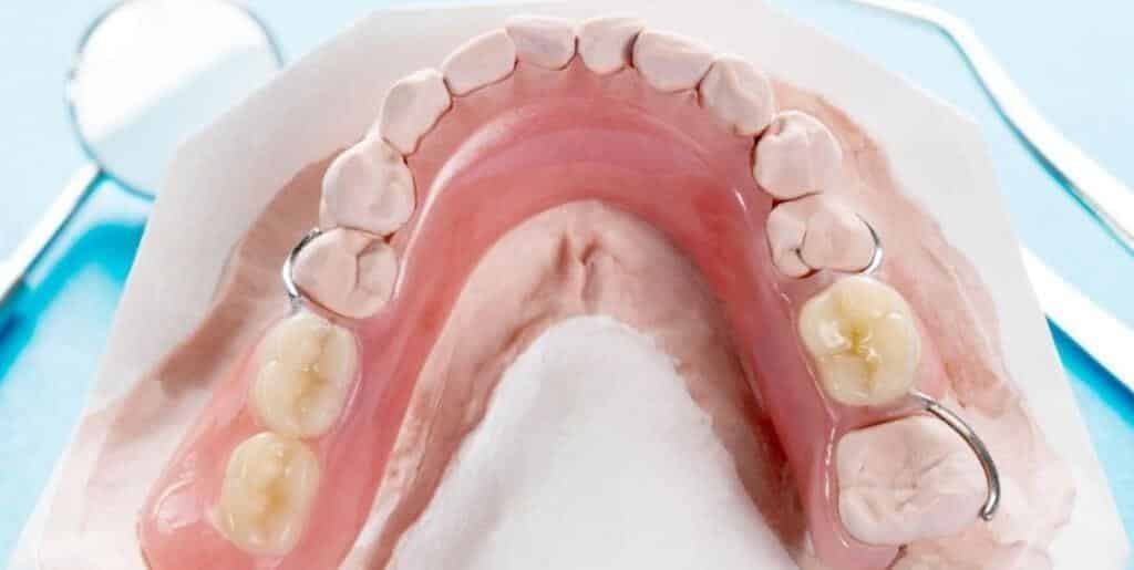 A partial denture with metal clasps on a model