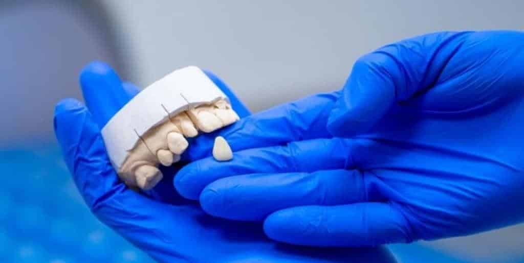 Gloved hands holding a dental model and a tooth-shaped restoration