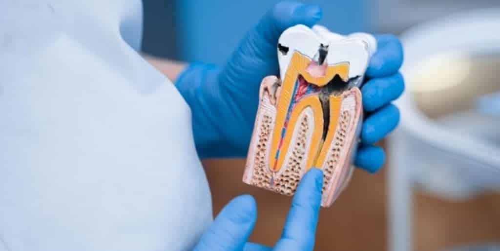 Gloved hands holding a model showing the inside of a tooth