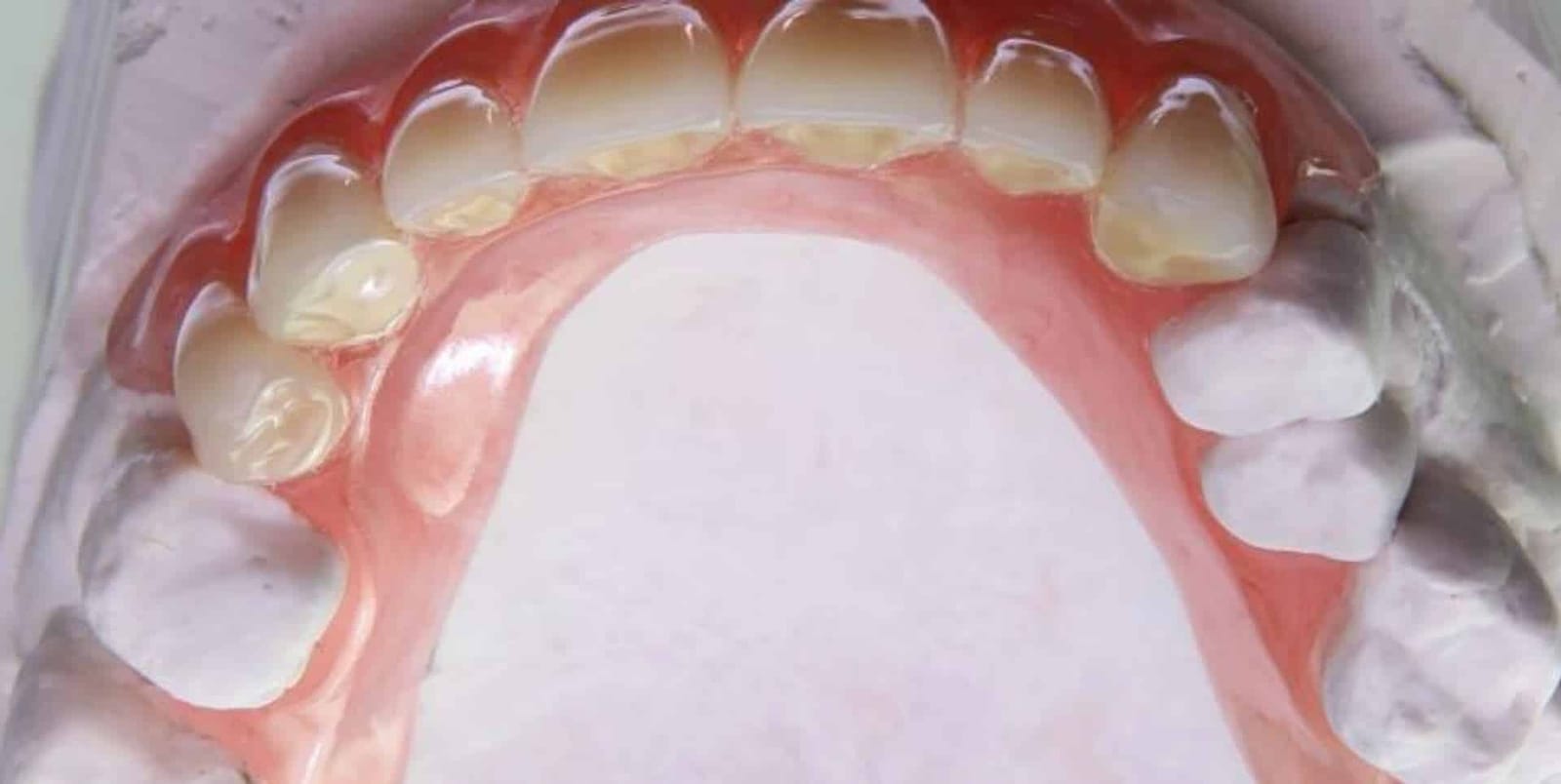 A partial denture on a dental model