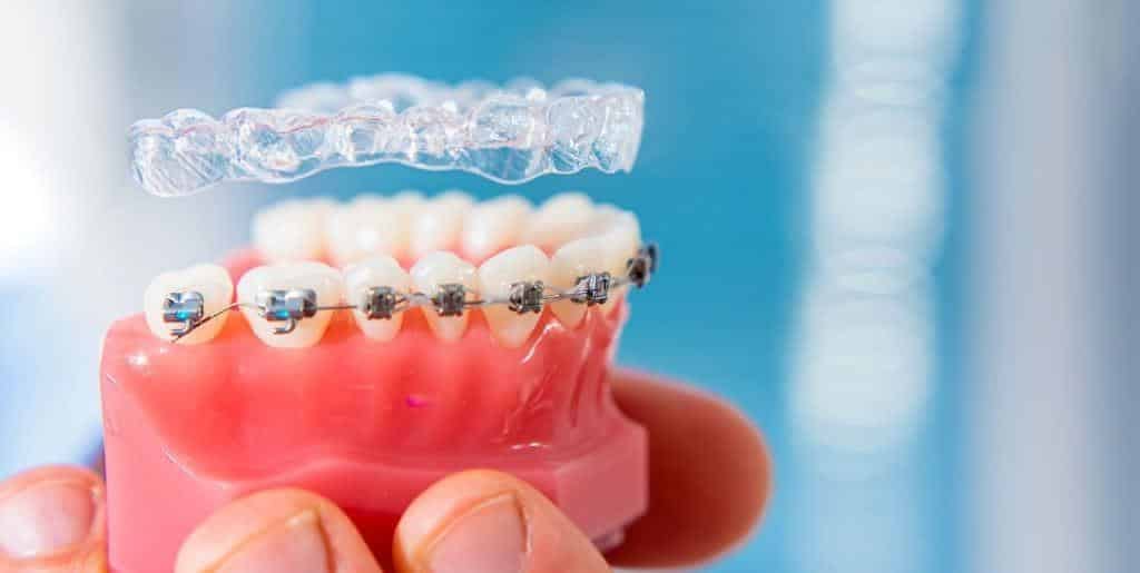 A clear tray held above a dental model with fixed braces