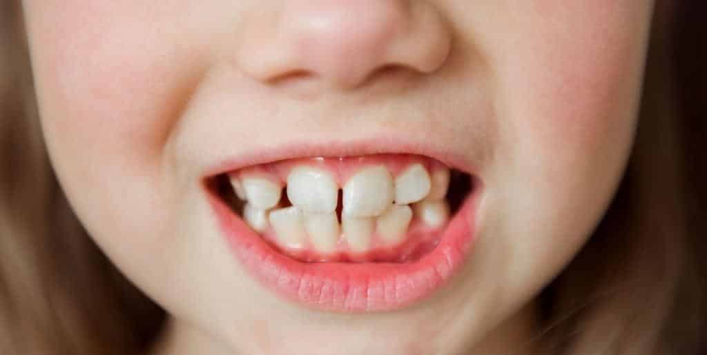 A close-up of a child’s teeth during the change from milk to adult teeth
