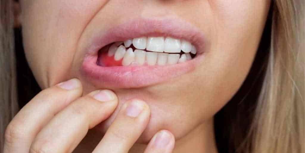 Person pulling down their lower lip to show the gum line