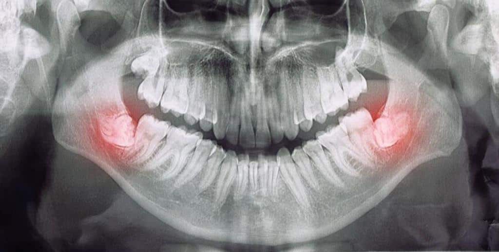 A panoramic dental X-ray with added red highlights near the lower wisdom teeth