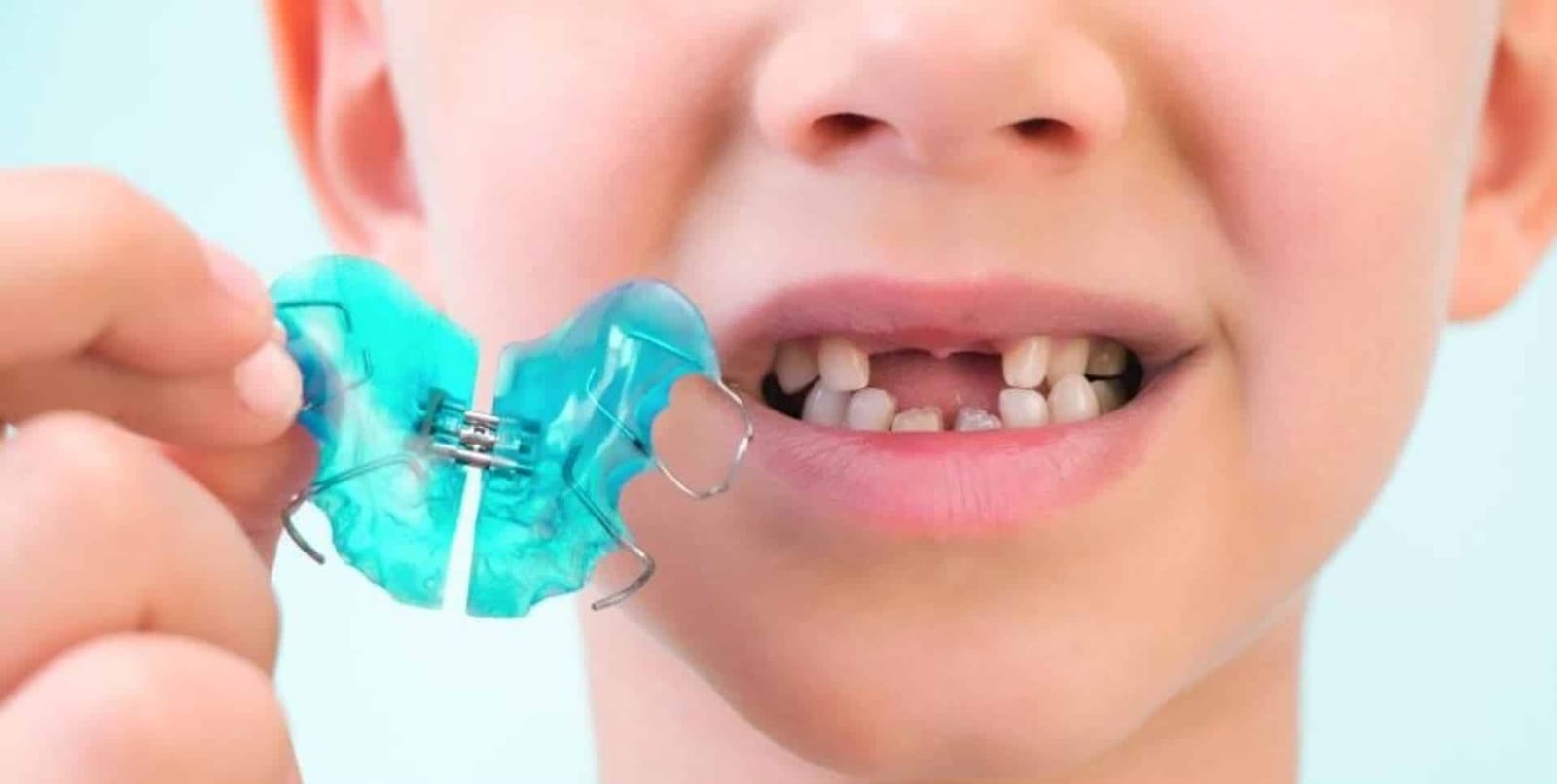 A child holding a blue removable orthodontic appliance