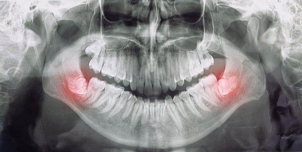 A panoramic dental X-ray with red markings near the lower back teeth