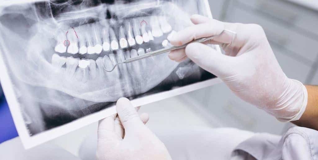 Gloved hands pointing to a panoramic dental X-ray