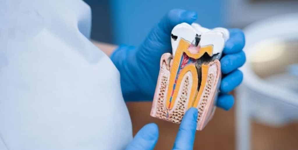 A gloved hand holding a model of a tooth in cross-section