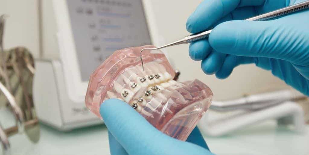 Gloved hands holding a dental model fitted with braces