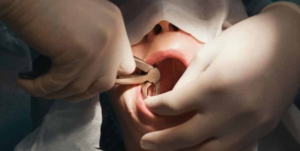 Dentist using instruments during a tooth extraction
