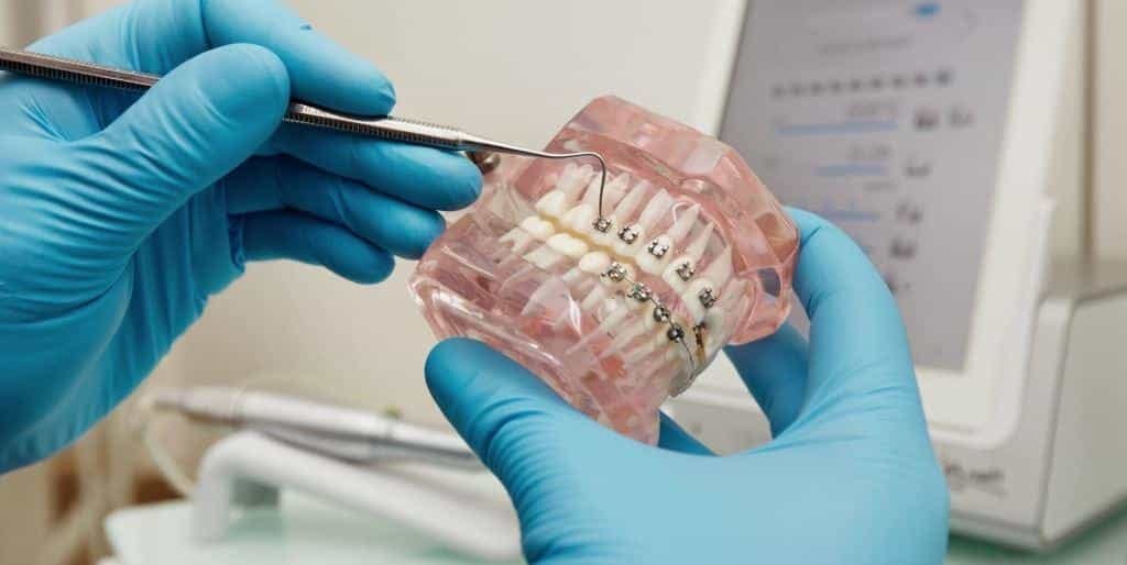 A dental model showing brackets and an orthodontic wire