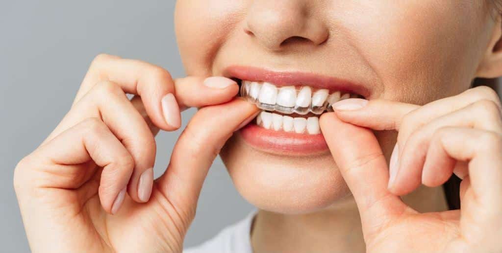 A person fitting a clear aligner over their teeth