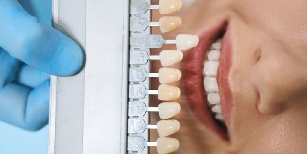 A tooth shade guide held beside a patient’s teeth